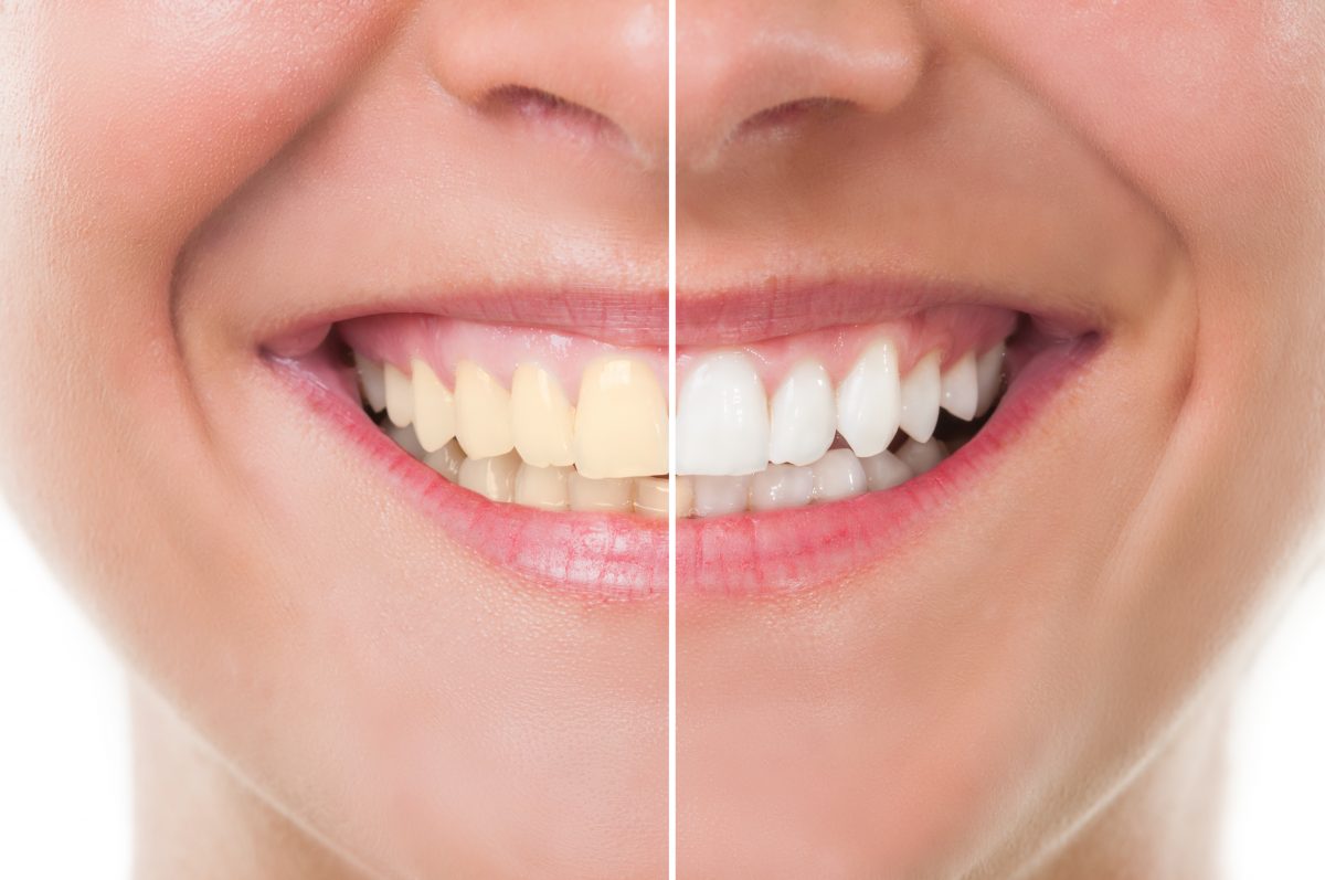 Is Teeth Whitening Right for You? | Litchfield MN