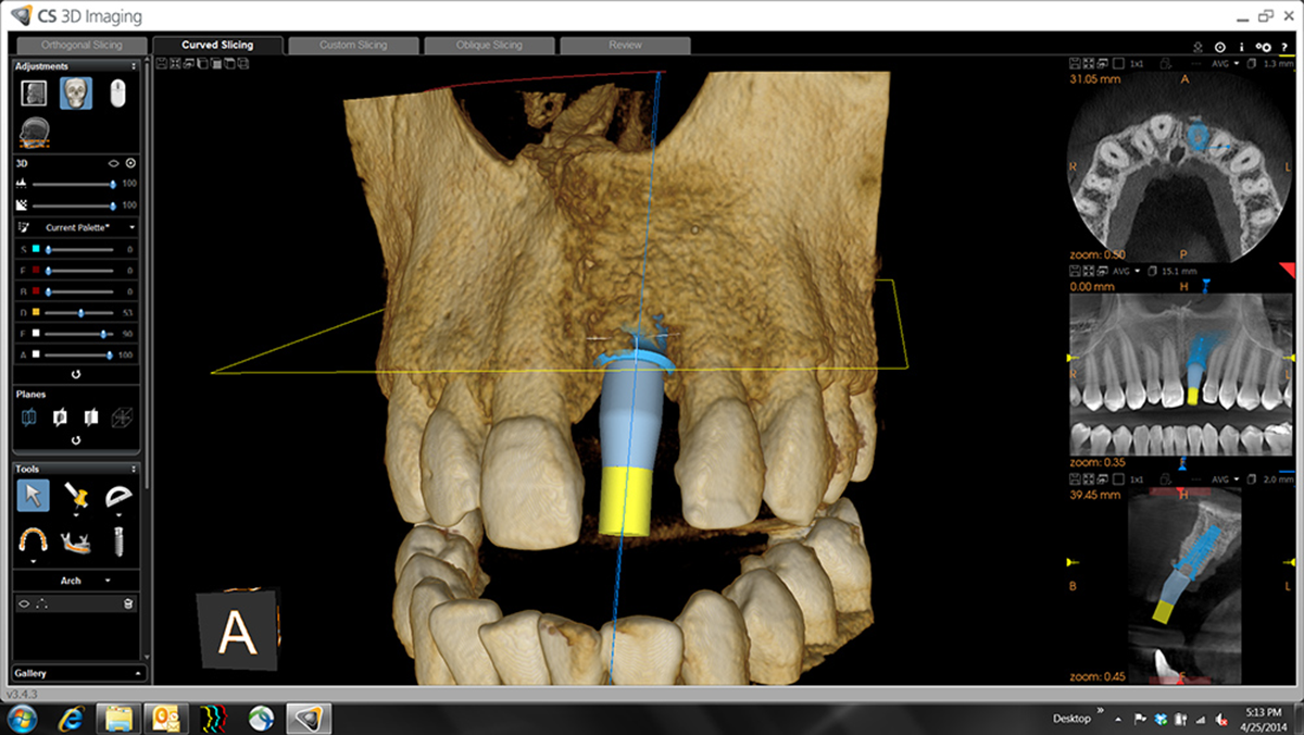 How Your Oral Surgeon Uses Cone Beam CT for Less Invasive Dental Surgery | Litchfield MN