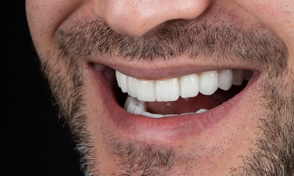 Common Questions: Teeth Whitening Treatment in Litchfield MN