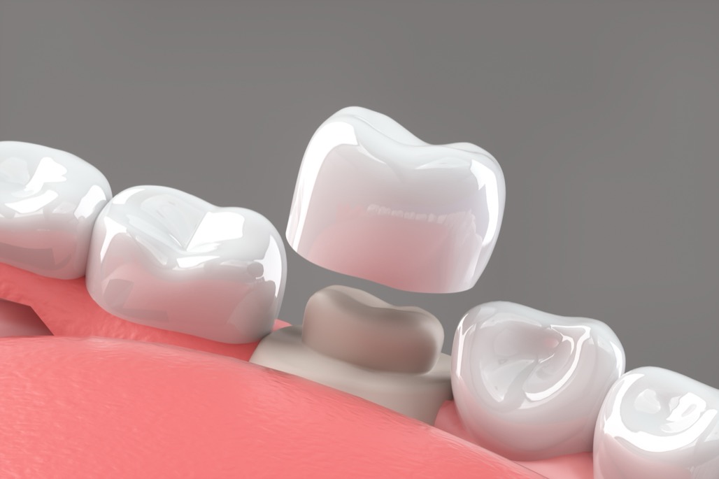 Dental Crowns Near Me in Litchfield