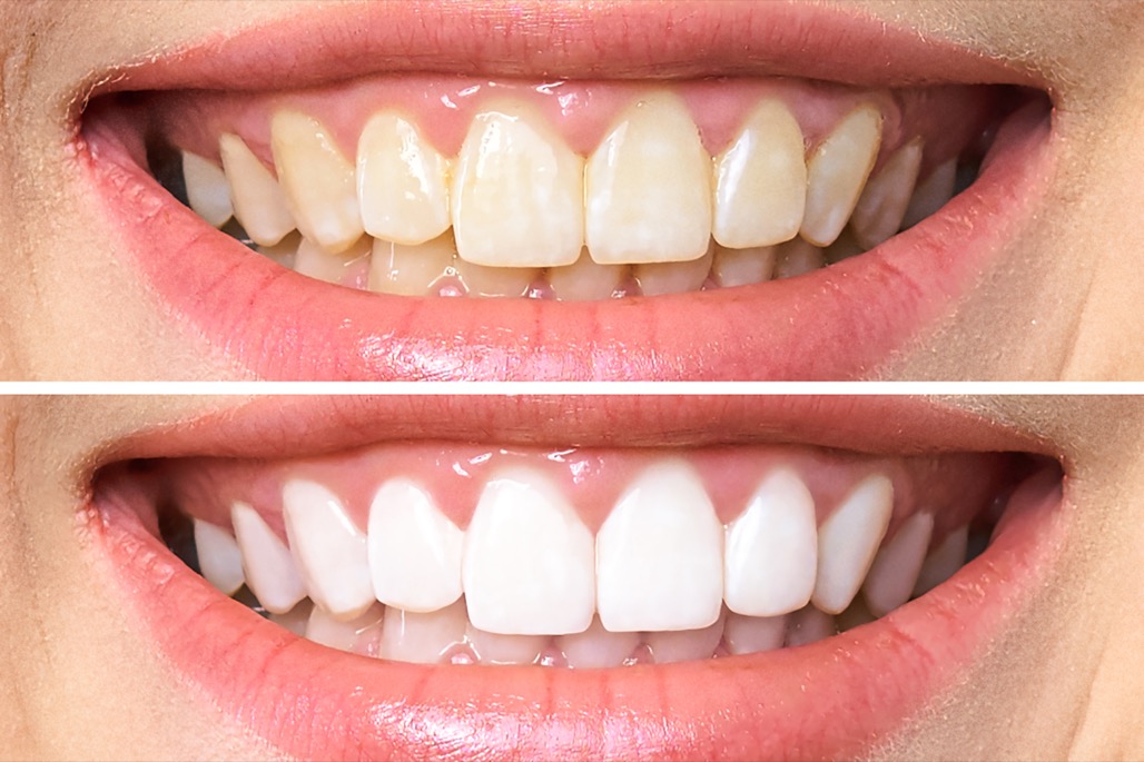 Teeth Whitening Treatment in Litchfield