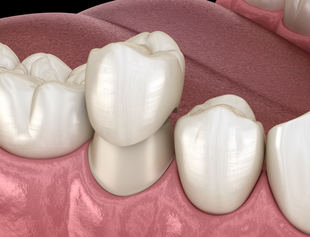 Dental Crowns Near Me in Litchfield