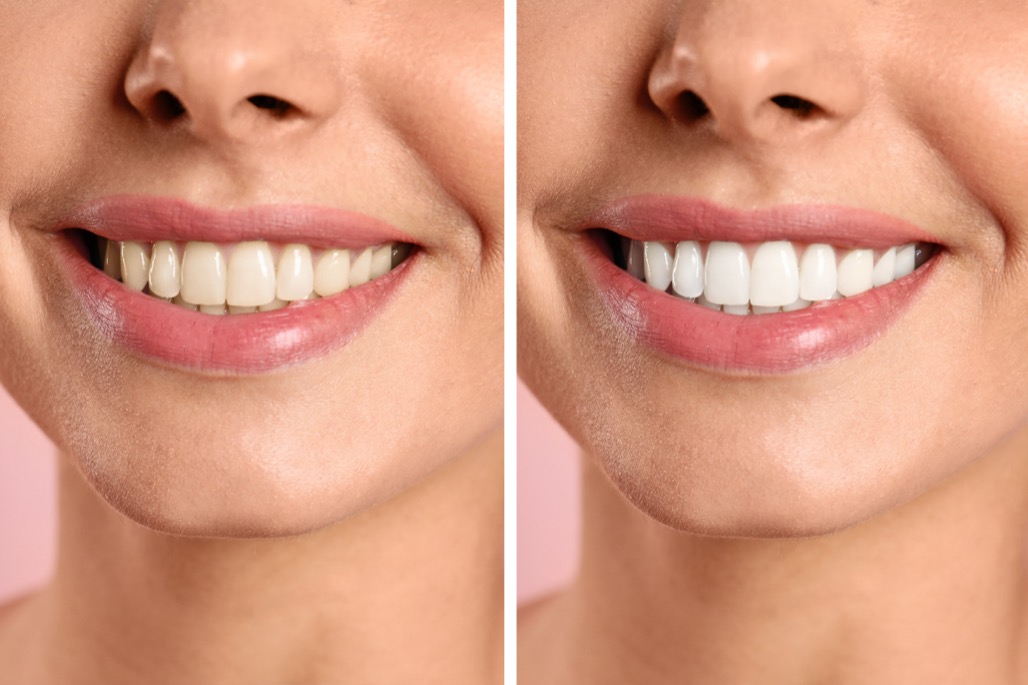 Teeth Whitening Treatment in Litchfield