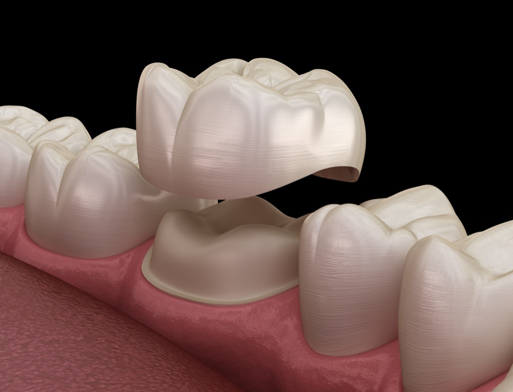 Dental Crowns Near Me in Litchfield