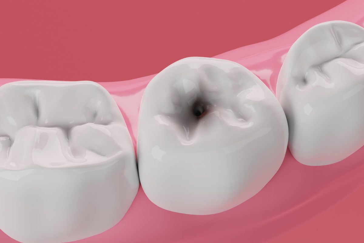 I May Need a Dental Filling, Which Dentist Can Help in Litchfield, MN?