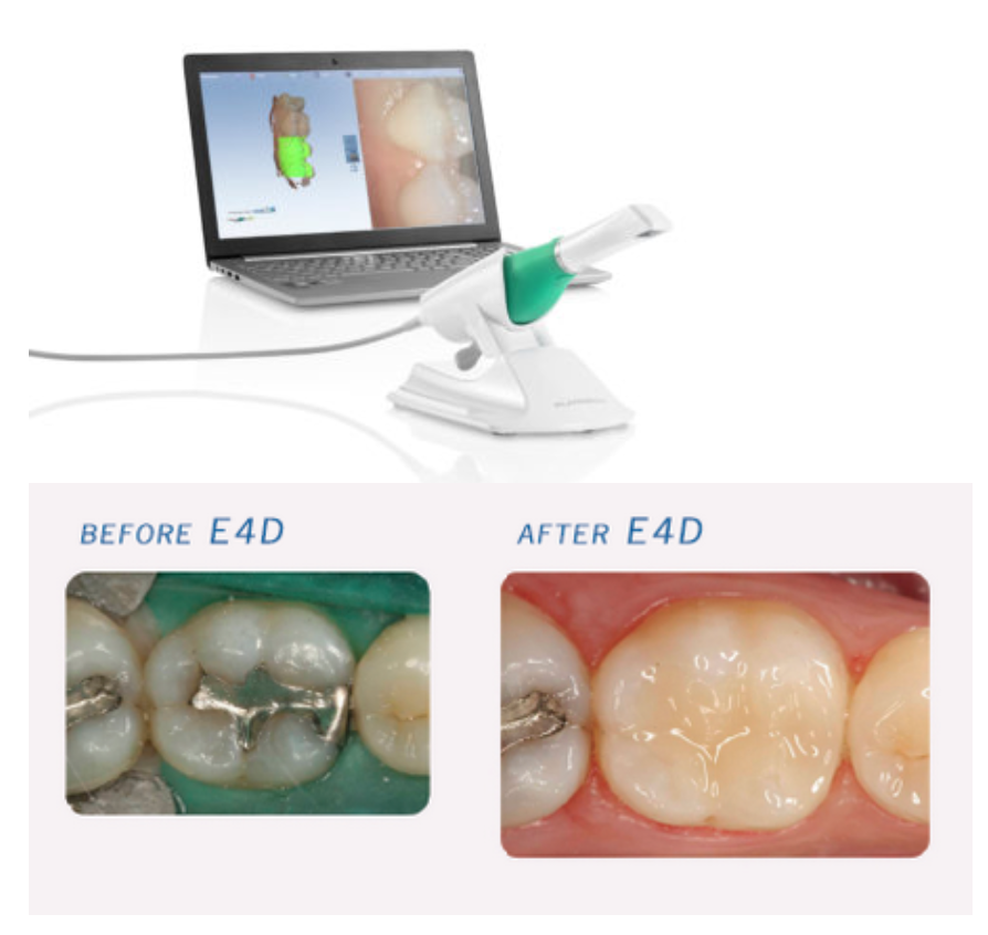 same-day dental crowns